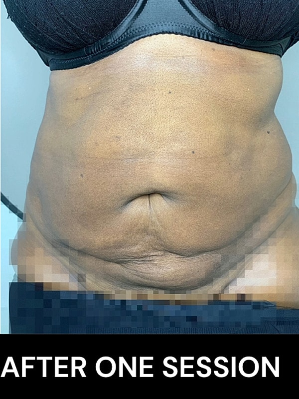 Morpheus8 Before & After