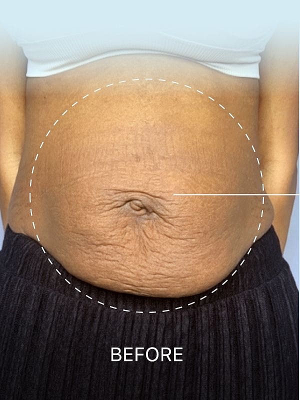 Before image showing abdomen with stretch marks.