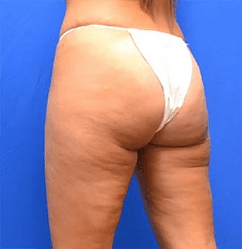 Brazilian Butt Lift  Before & After