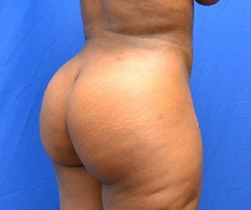 Brazilian Butt Lift  Before & After