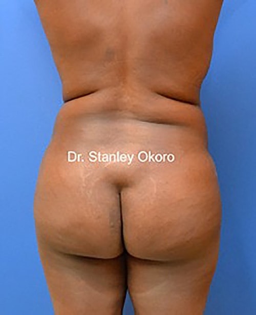 Brazilian Butt Lift  Before & After