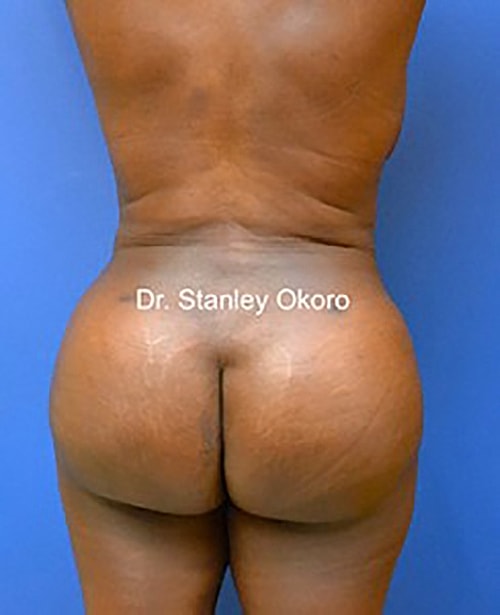 Brazilian Butt Lift  Before & After