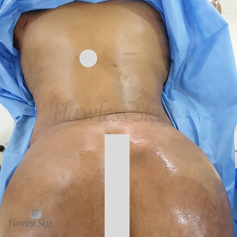 Brazilian Butt Lift  Before & After