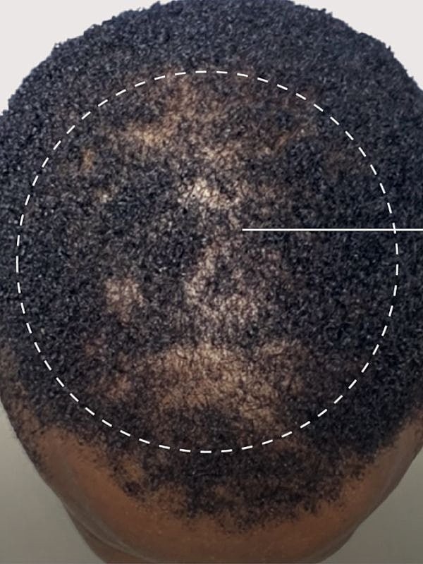 Close-up of scalp with hair loss pattern.