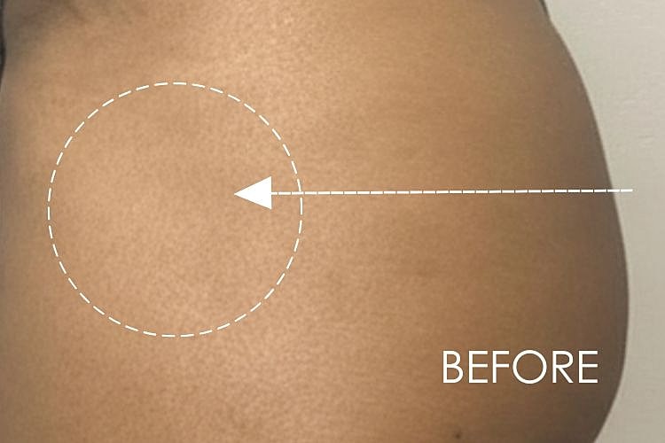 Hip Fillers Before & After
