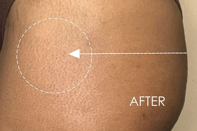 Hip Fillers Before & After