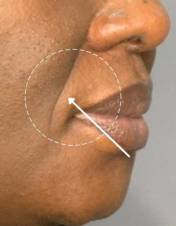 Dermal Fillers Before & After