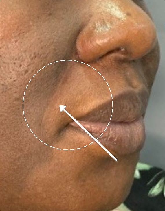 Dermal Fillers Before & After