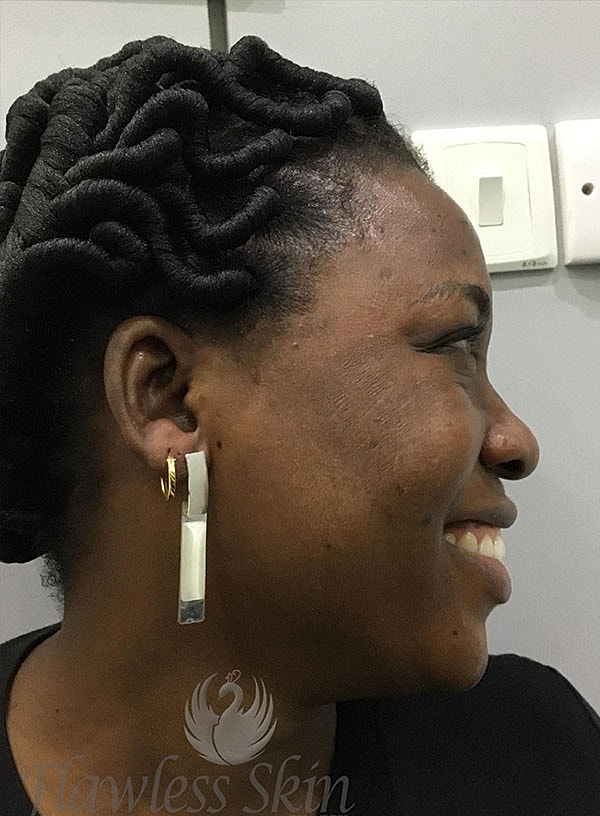 Hyperpigmentation Before & After