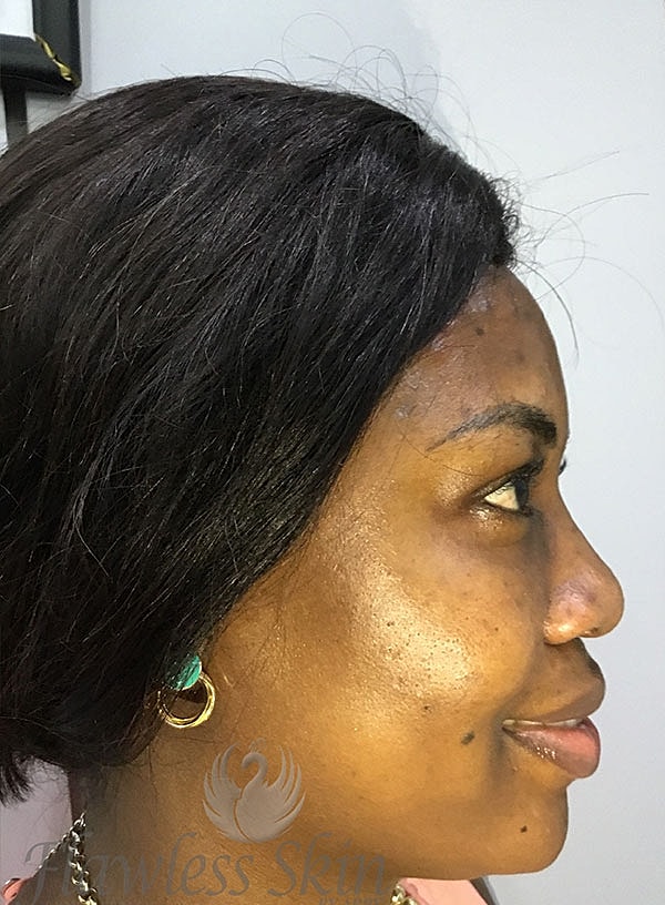 Hyperpigmentation Before & After