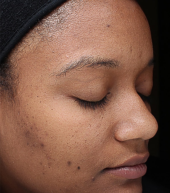 Hyperpigmentation Before & After