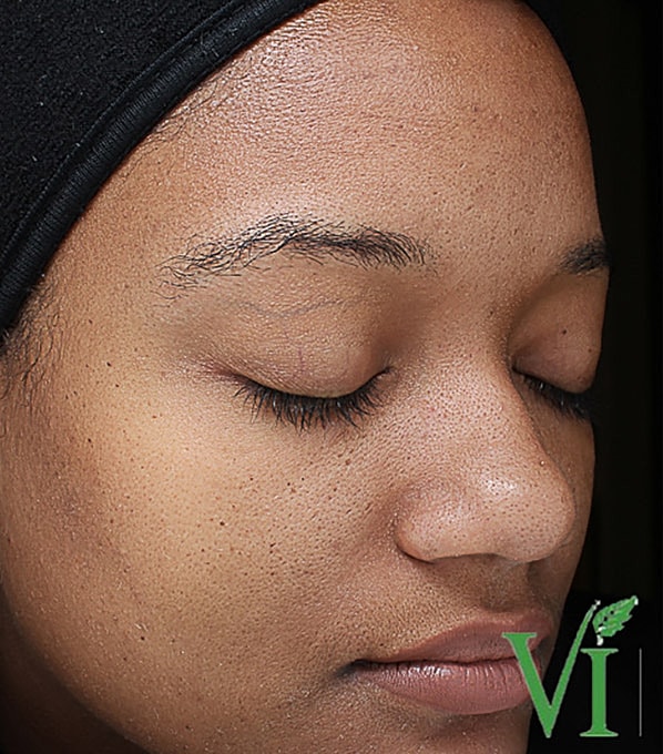 Hyperpigmentation Before & After