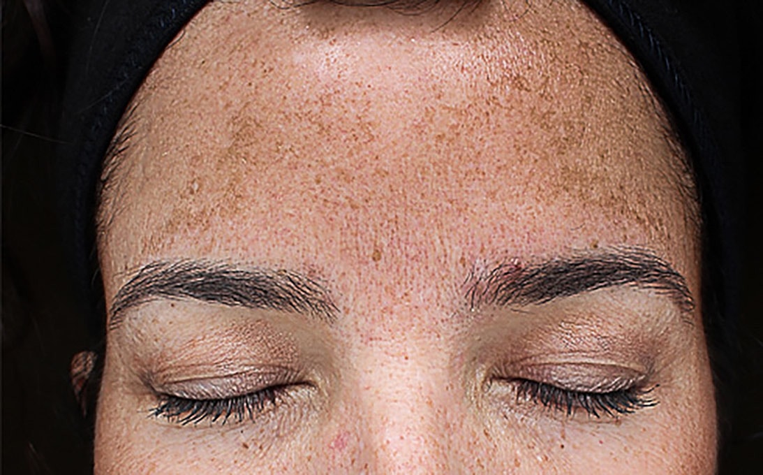 Hyperpigmentation Before & After