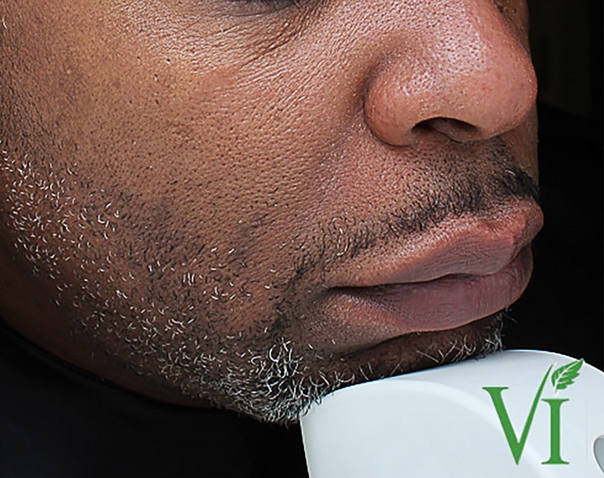 Hyperpigmentation Before & After