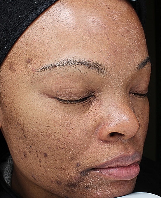 Hyperpigmentation Before & After