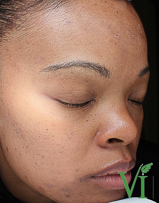 Hyperpigmentation Before & After