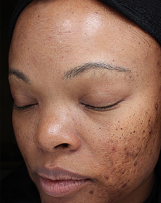 Hyperpigmentation Before & After