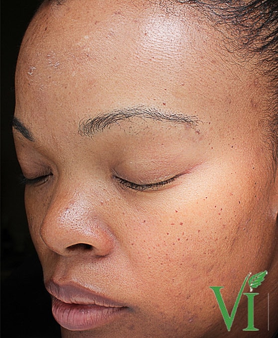 Hyperpigmentation Before & After