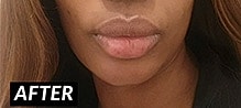 Lip Augmentation Before & After