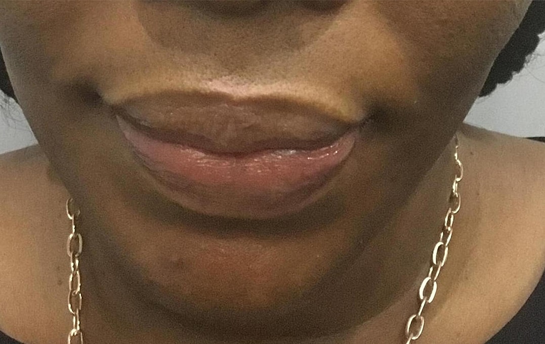 Lip Augmentation Before & After