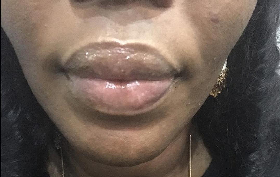 Lip Augmentation Before & After