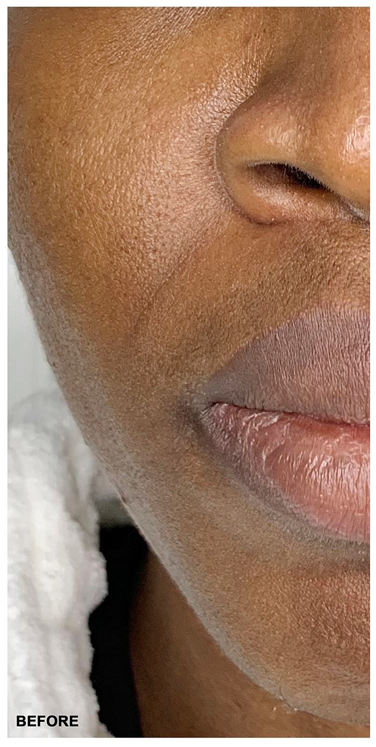 Lip Augmentation Before & After