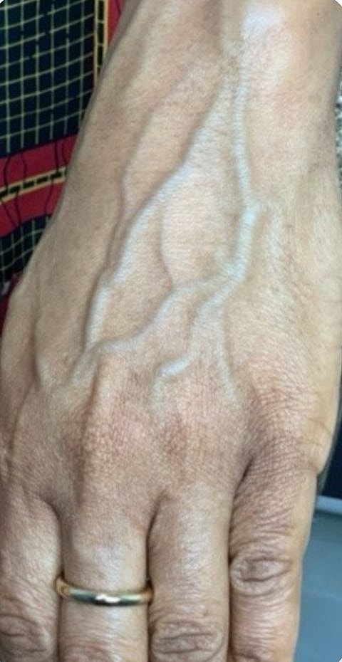 Hand Fillers Before & After