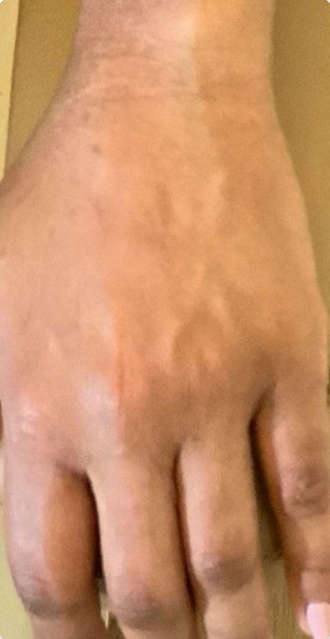 Hand Fillers Before & After