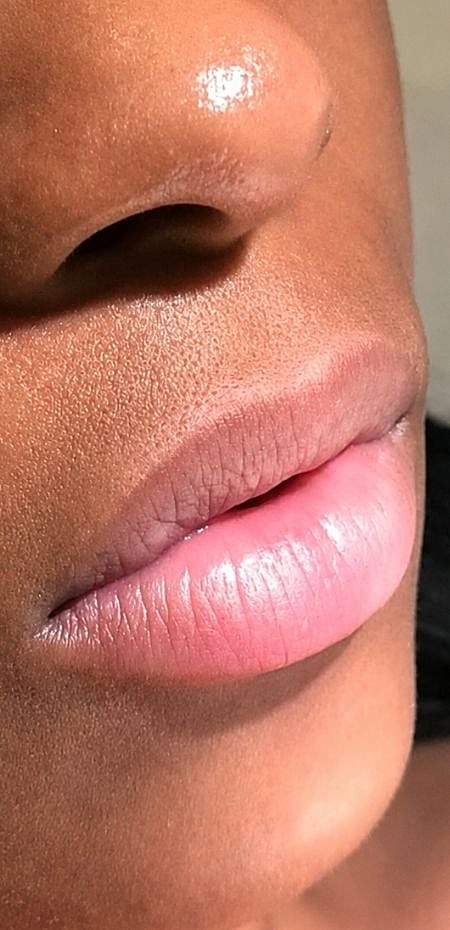 Lip Fillers Before & After