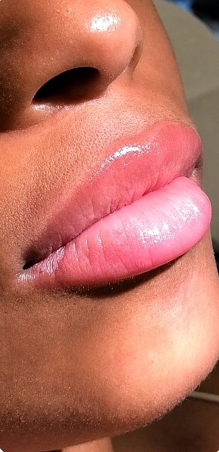 Lip Fillers Before & After