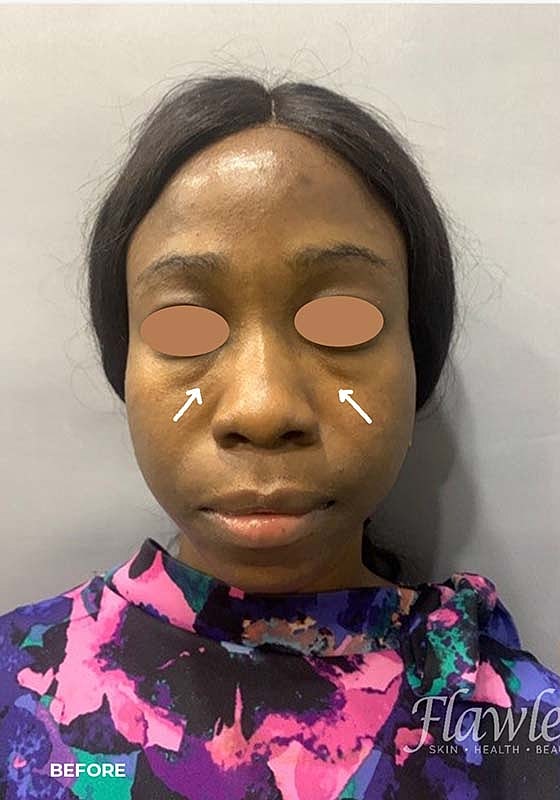 Tear Trough And Under Eye Fillers Before & After