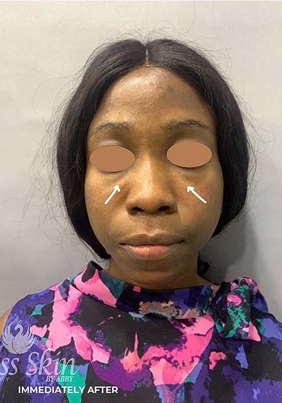 Tear Trough And Under Eye Fillers Before & After