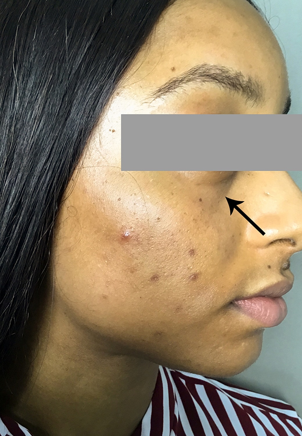 Tear Trough And Under Eye Fillers Before & After