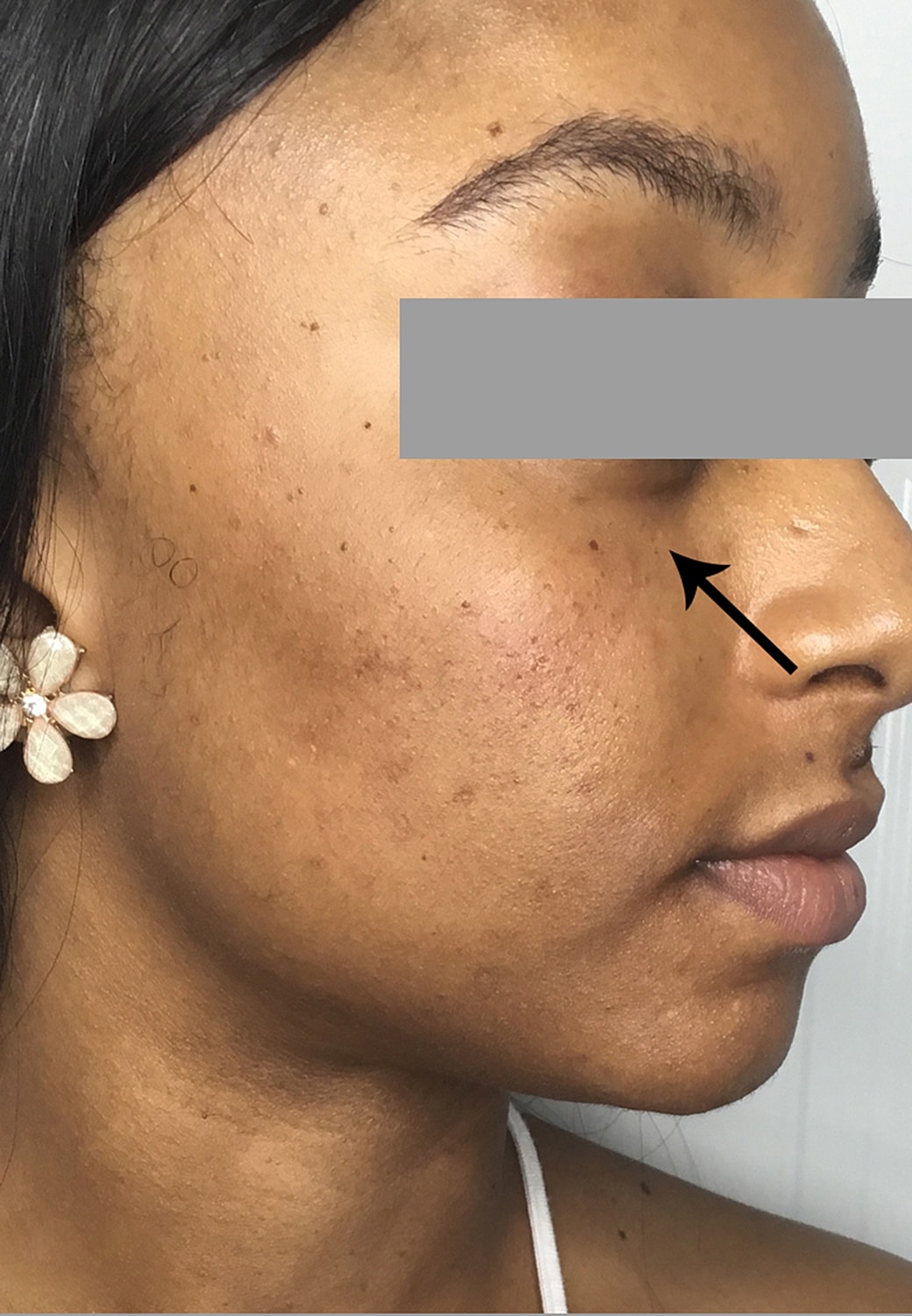 Tear Trough And Under Eye Fillers Before & After