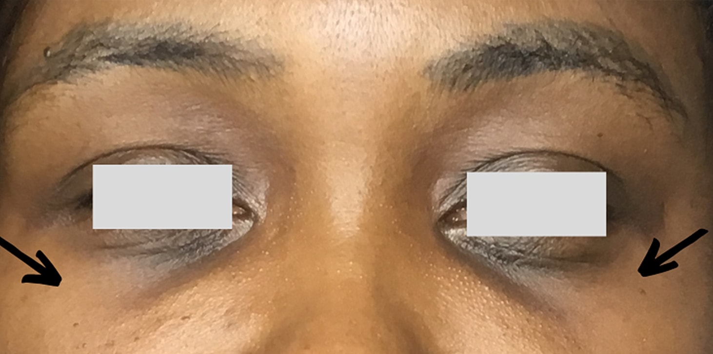 Tear Trough And Under Eye Fillers Before & After
