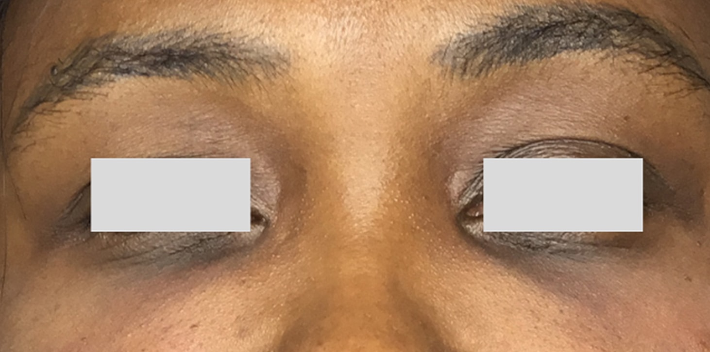 Tear Trough And Under Eye Fillers Before & After