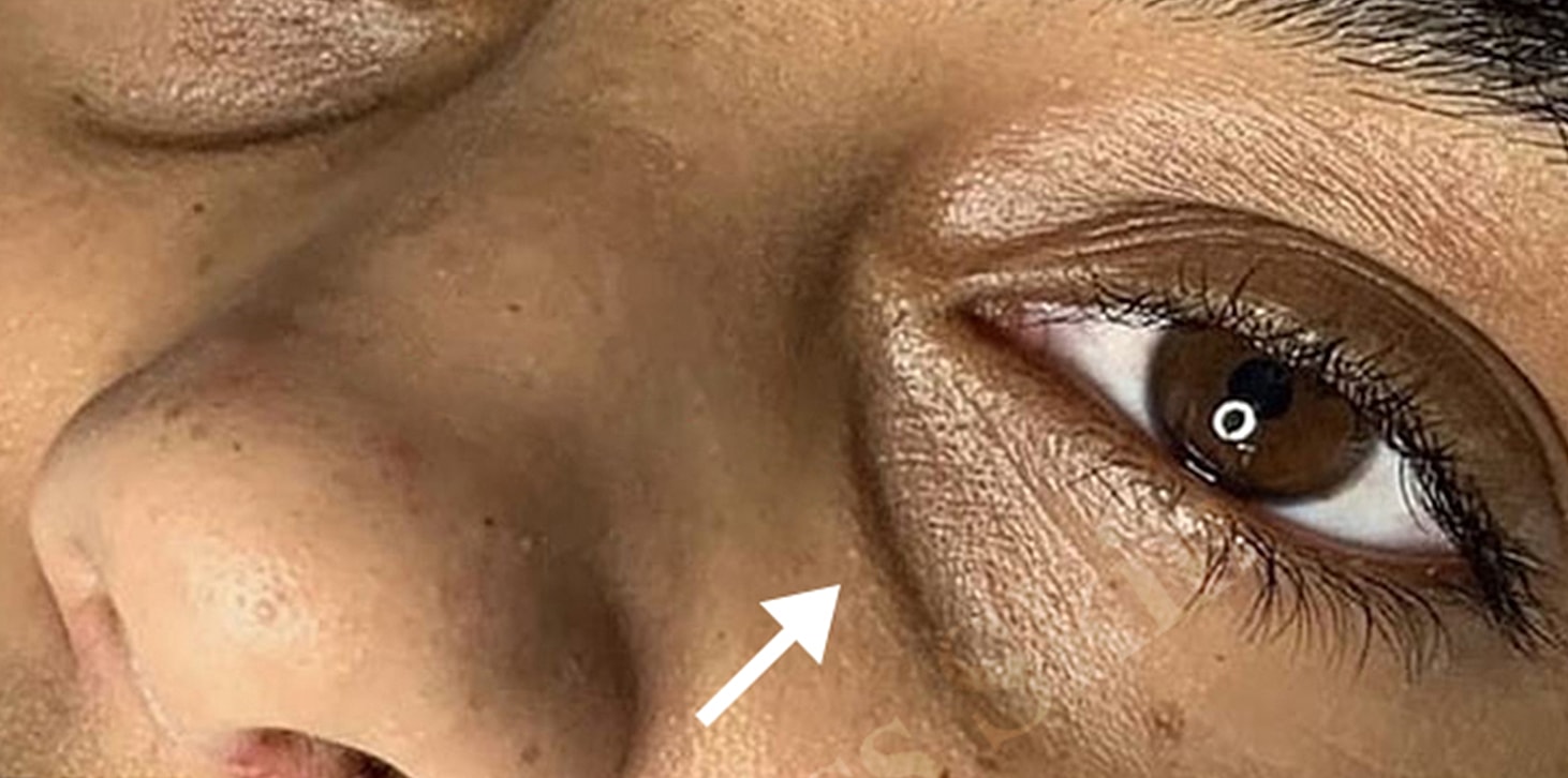 Tear Trough And Under Eye Fillers Before & After