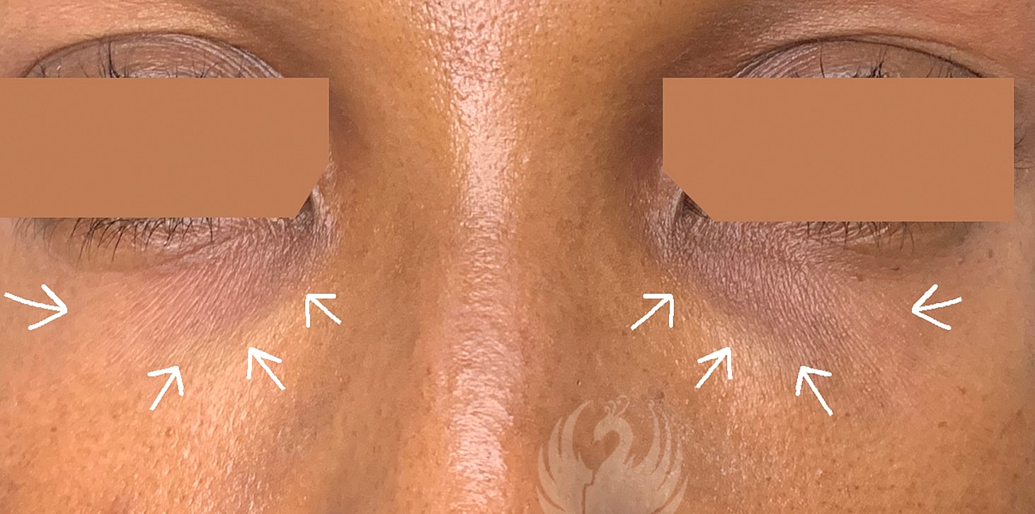 Tear Trough And Under Eye Fillers Before & After