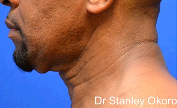 Thermineck And Thermilift Before & After