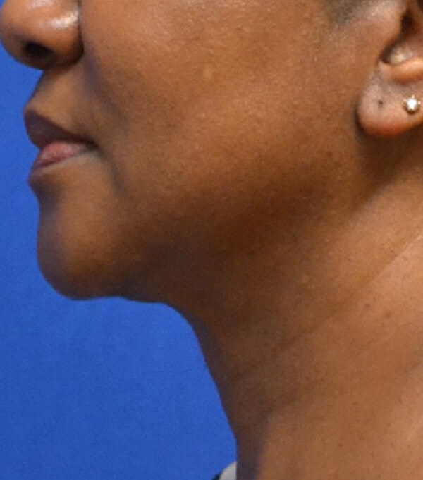 Thermineck And Thermilift Before & After