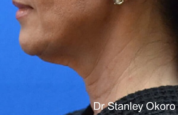 Thermineck And Thermilift Before & After