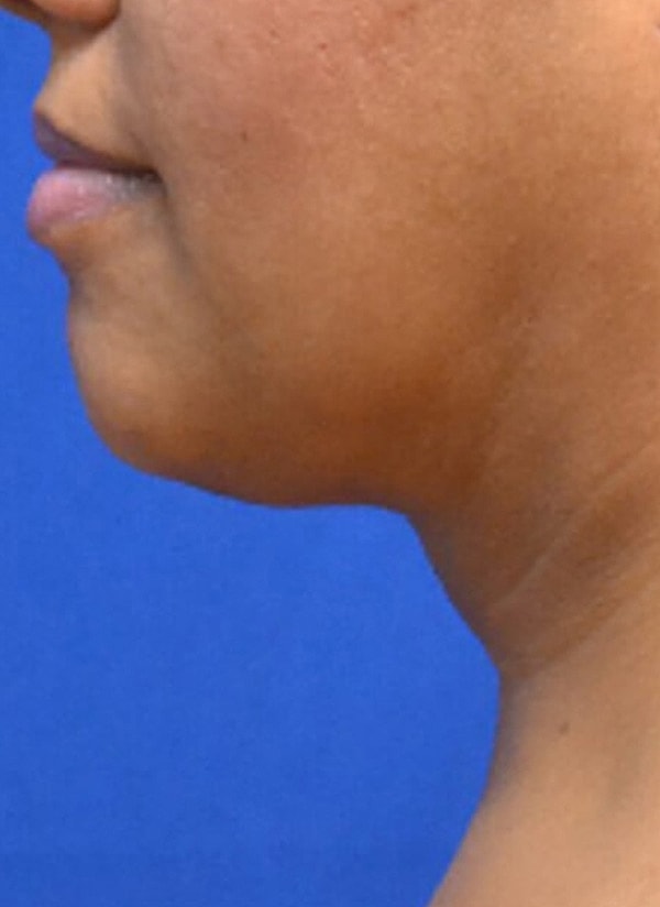 Thermineck And Thermilift Before & After