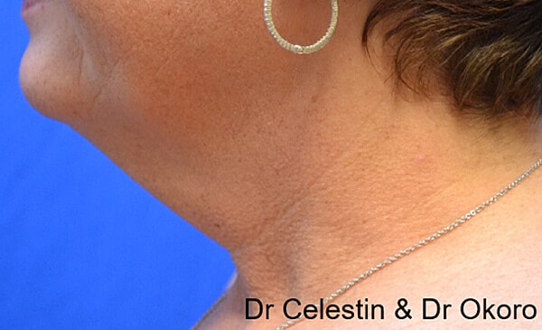 Thermineck And Thermilift Before & After