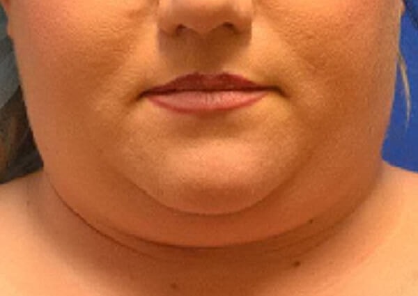 Thermineck And Thermilift Before & After