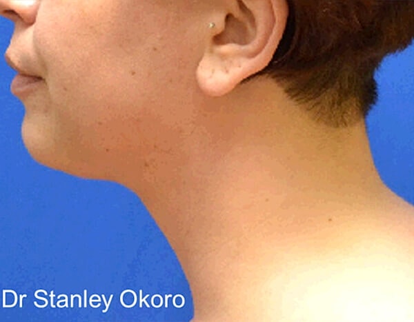 Thermineck And Thermilift Before & After