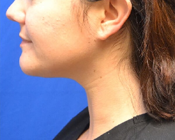 Thermineck And Thermilift Before & After