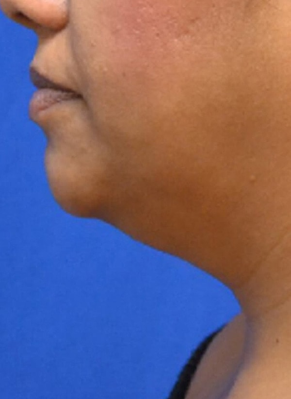 Thermineck And Thermilift Before & After