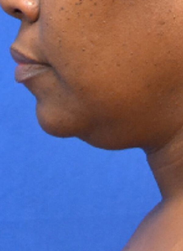 Thermineck And Thermilift Before & After