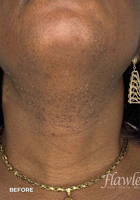 Laser Hair Removal Before & After