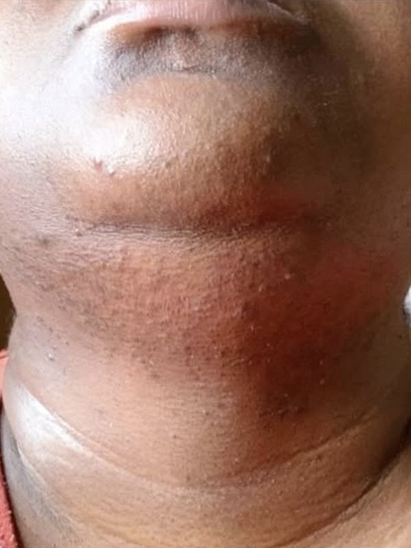 Close-up of a neck and chin area.